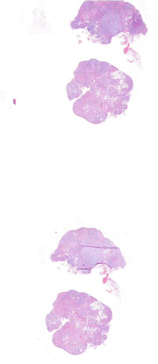 Cutaneous Angiolipoleiomyoma KiKo XP