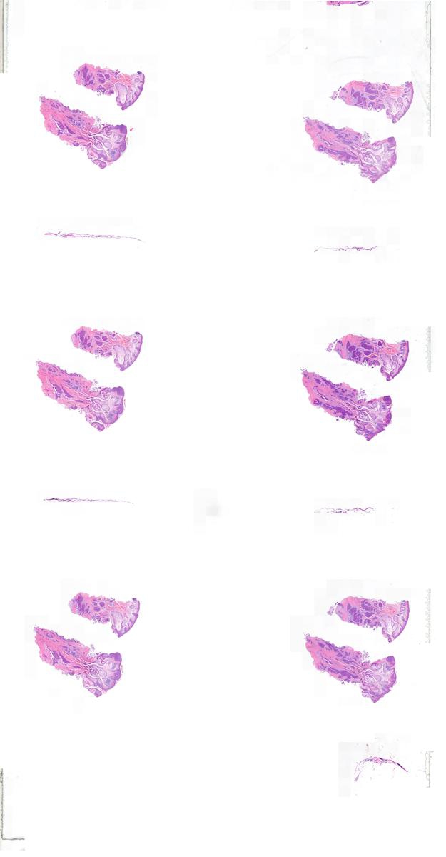 Apocrine Carcinoma EMPSGC With BCL2 Positivity KiKo XP