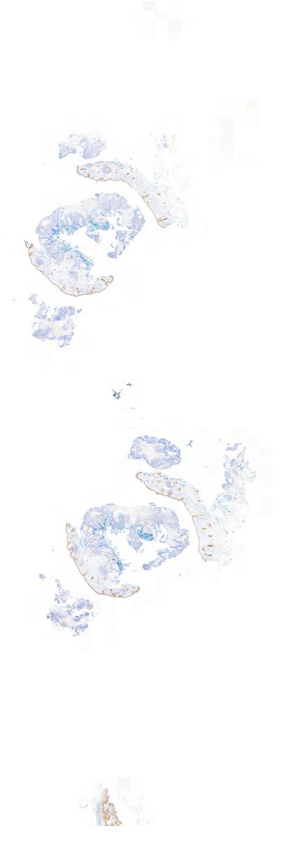 P Immunopositivity Of Merkel Cell Carcinoma Kiko Xp