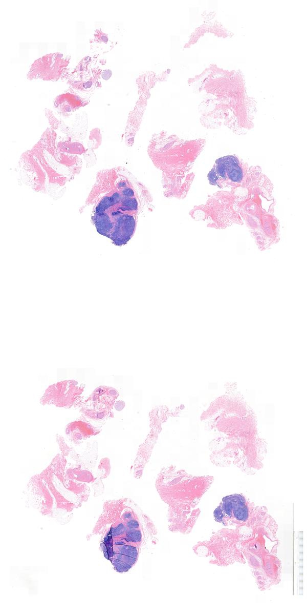 Reactive lymphadenitis presenting as a follicular cyst kiko xp