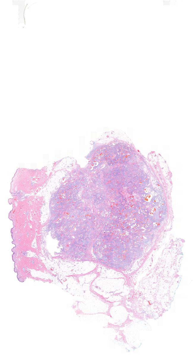 Myxoid spindle cell lipoma with desmin immunopositivity KiKo XP