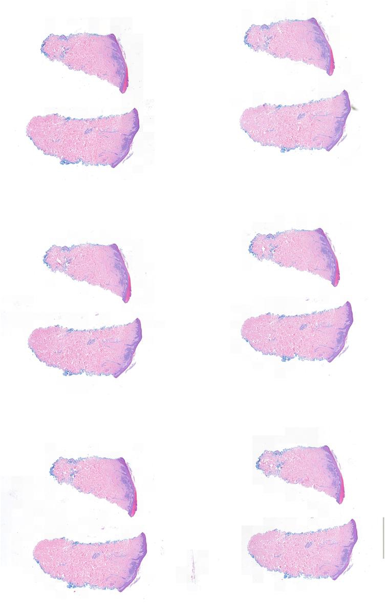 Hypertrophic lichenoid drug reaction with syringosquamous metaplasia ...