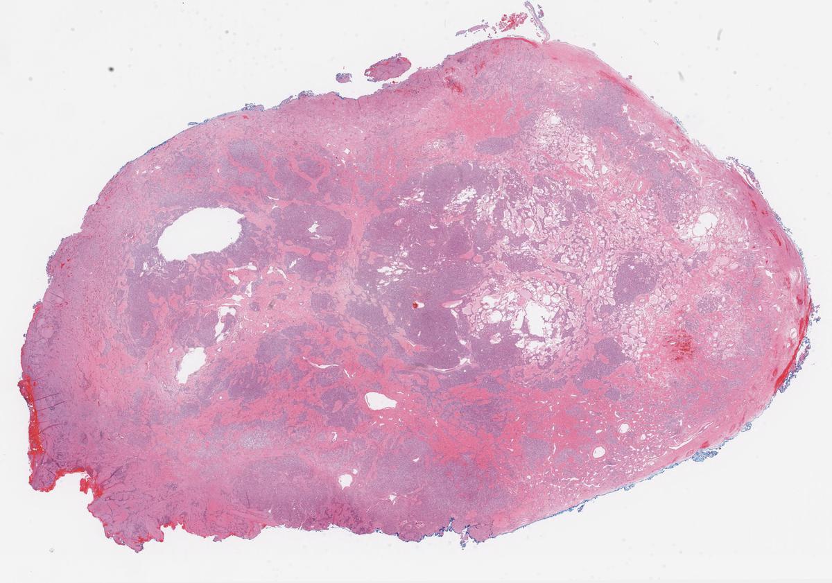 Paraganglioma glomus vagale with nice s100 sustentacular cells and