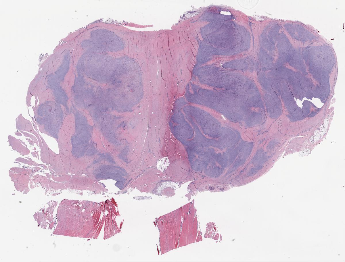 (Masterclass case 4) adult man with slowly growing plantar foot mass