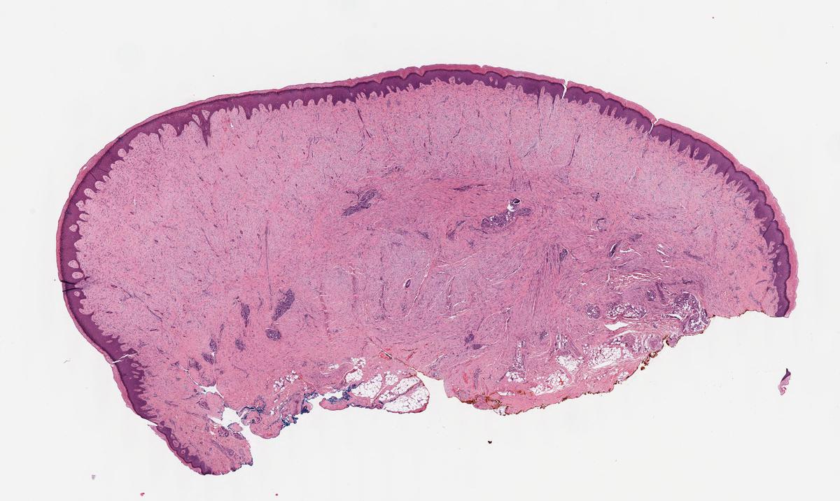 Skin Nodule On Toe Of Baby. Diagnosis? 