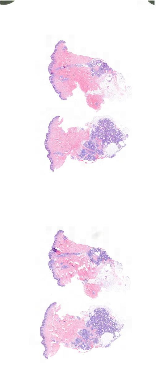 lactational-adenoma-arising-in-a-supernumerary-nipple-kiko-xp