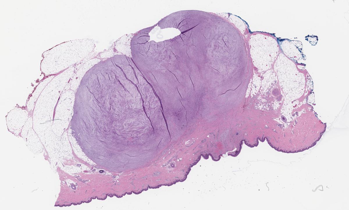 Rush Pathology IRAP23 Case 2 (Derm/Soft tissue) | KiKo XP