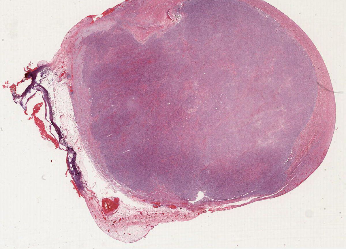 Deep soft tissue mass in adult. Diagnosis? KiKo XP