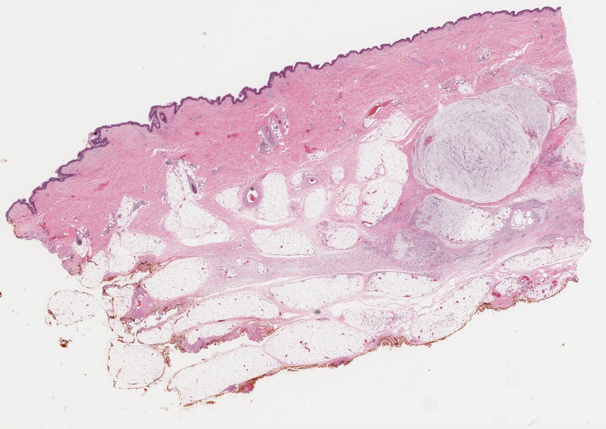 70 yo woman with skin nodule on thigh. Clinical diagnosis "sebaceous cyst". KiKo XP