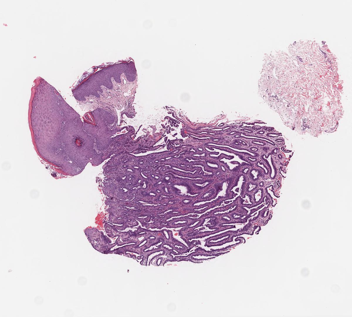 nipple-adenoma-erosive-adenomatosis-of-the-nipple-wsi-digital-slide